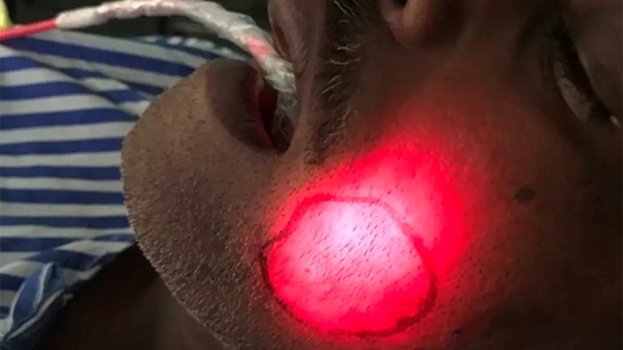 Patient-01-PDT-Treatment-Wide